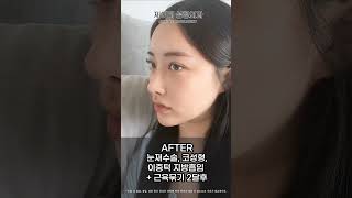 눈코성형+이중턱지흡까지! 새로 태어난 기분😎