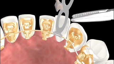 Incognito™ Appliance System Clinical Guide 07:  Lasso Elastic (O Lasso)