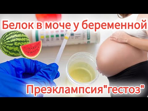 Белок в моче у беременной. Личный опыт. Преэклампсия (в прошлом "гестоз"). Протеинурия.