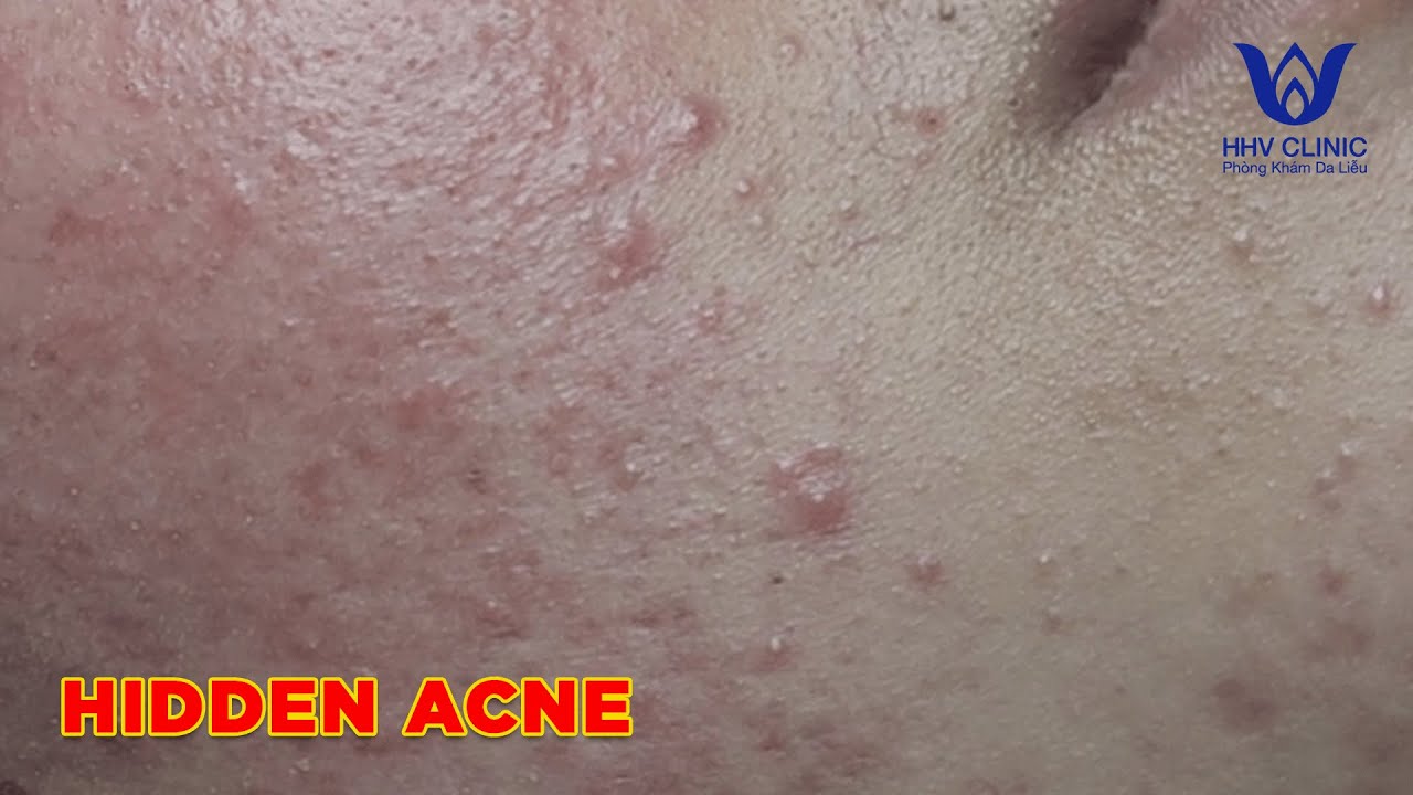 HHV Clinic | dothuhien | hienvanspa - Hidden acne