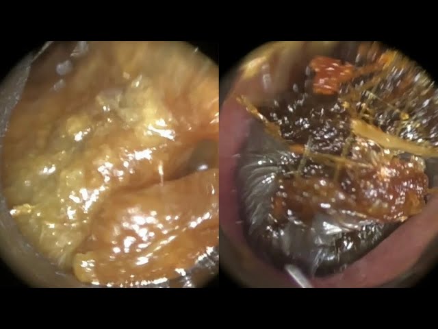 145 - Masses of Ear Wax Removed from Interior & Anterior Recess of Bendy Ear using WAXscope®️ class=