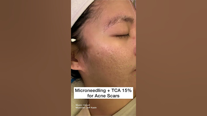Microneedling plus TCA 15% peel for Acne Scars #Shorts