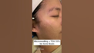 Thumbnail of Microneedling plus TCA 15% peel for Acne Scars #Shorts