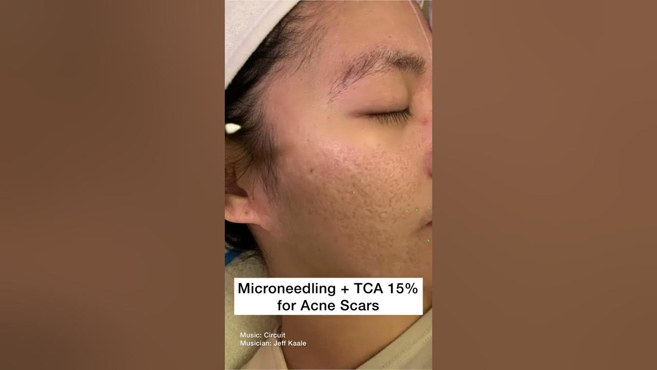 Microneedling plus TCA 15% peel for Acne Scars #Shorts