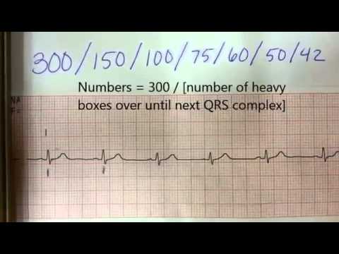 How To Find Heart Rate Pulse From Ekg Youtube