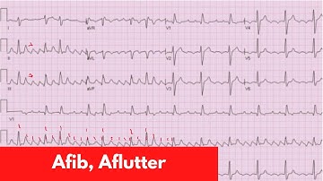 AFib, Aflutter, MAT | For DO, MD, NP, PA [Part 5]
