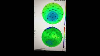 36yo pilot keratoconus progression despite stopping eye rubbing