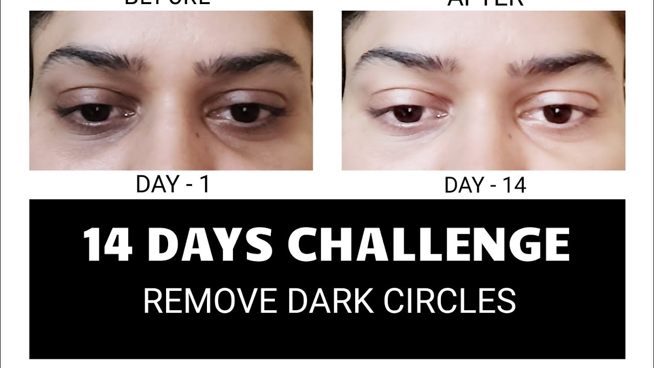 How to remove Dark Circles Permanently14 days challenge YouTube