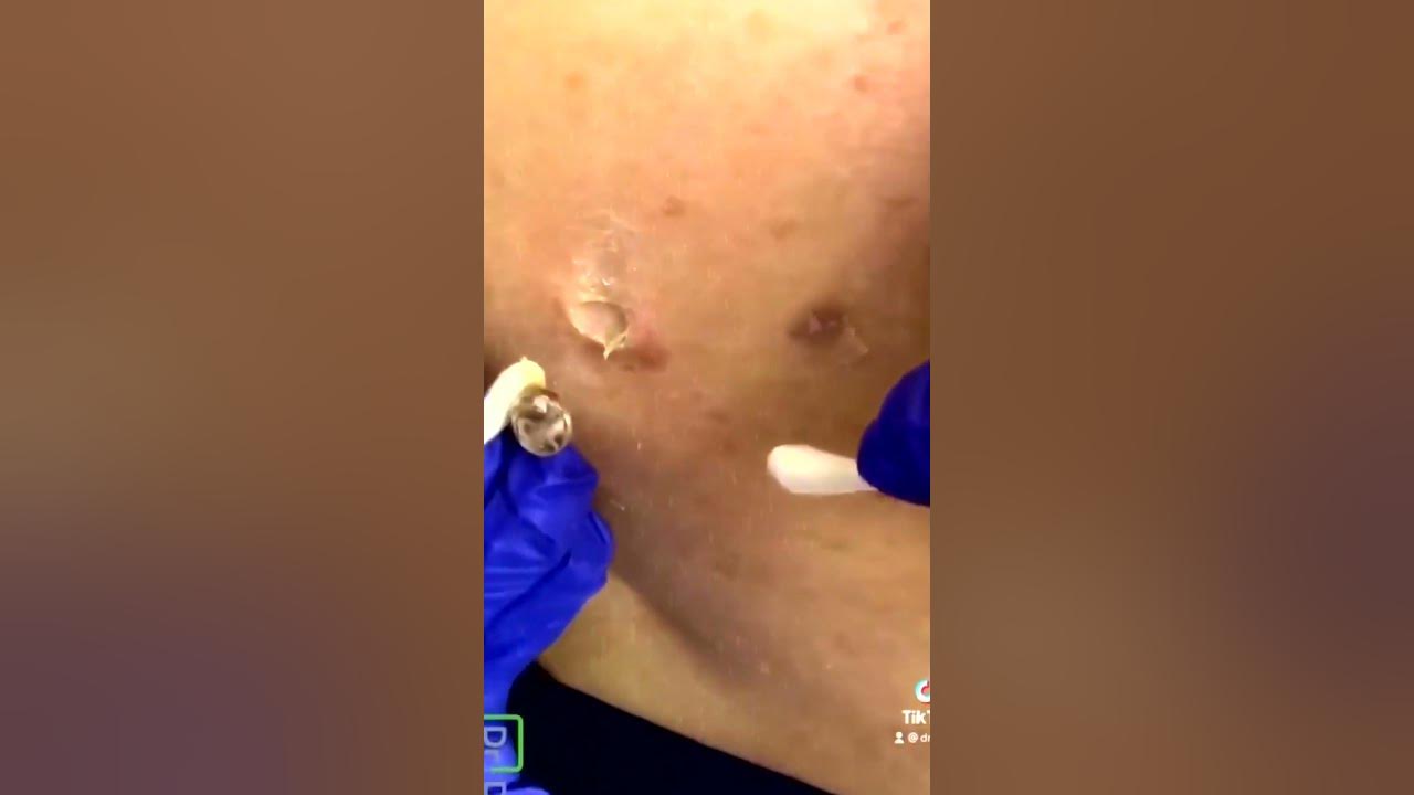Big pimples sac dep spa Loan nguyen large blackheads YouTube