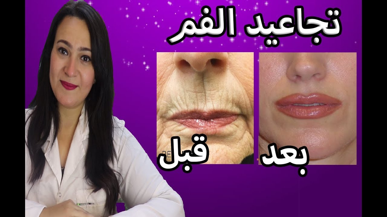 تخلصي من تجاعيد وخطوط الفم نهائيا بأقوى كريم بالقوة الثلاثية .. أقوى من البوتكس !!