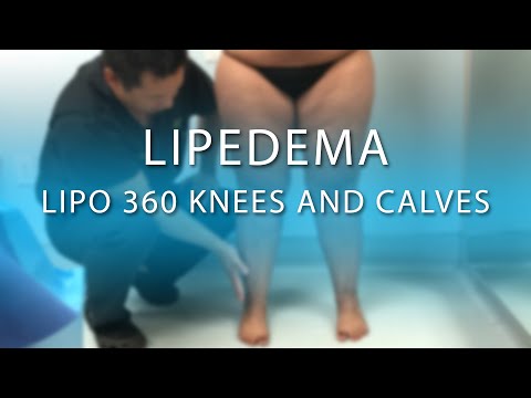 Lipedema Leg Surgery | Lipo 360 Knees and Calves | Liposuction Results | ArtLipo | Expert Dr. Su