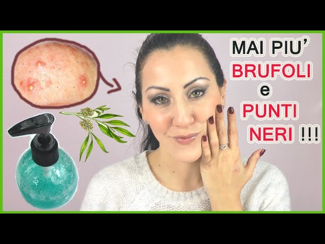 aloe vera per brufoli e punti neri