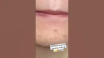 تبييض الوجه والبشرة للعيد خلال يوم فقط 