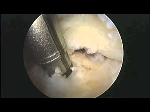 Video: Peesreparatiechirurgie: Redenen, Procedure En Herstel