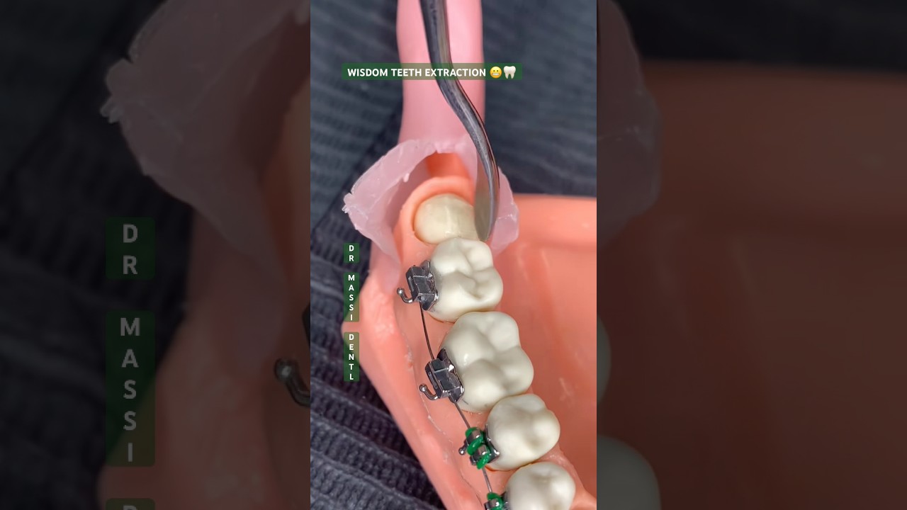 Удаление зубов мудрости 😬🦷
