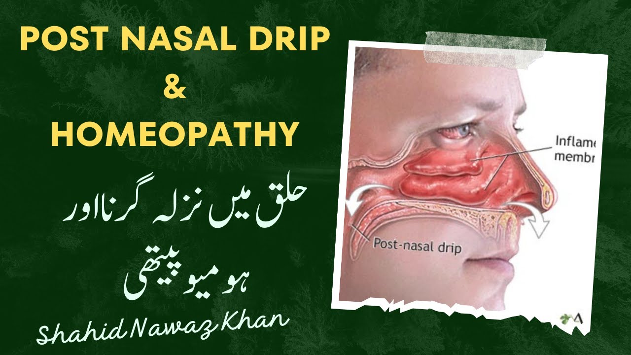 Post Nasal Drip & Homeopathy نزلہ کا حلق پر گرنا اور ہومیوپیتھی Shahid Nawaz Khan YouTube