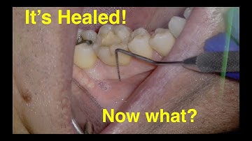 Sinus Tract Healed - Should I finish the Root Canal? #AllThingsDentistry