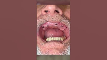 Time to ditch traditional dentures! Snap in dentures are more comfortable and easy to put in! ✨