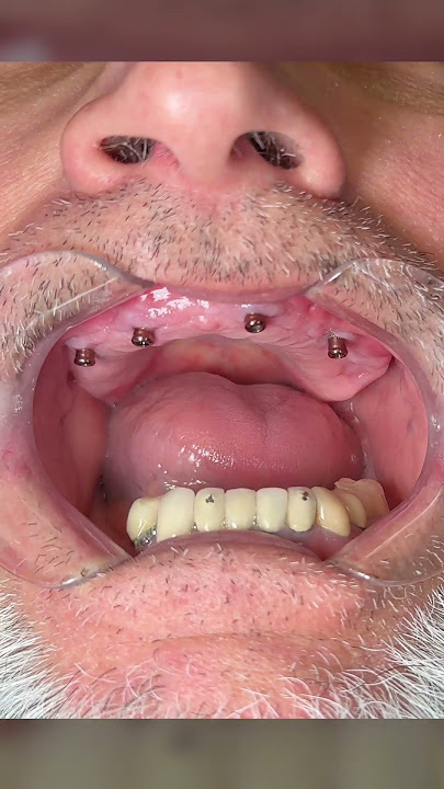 Time to ditch traditional dentures! Snap in dentures are more comfortable and easy to put in! ✨