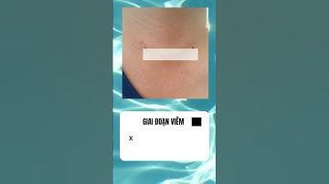 Bệnh nhân mổ tuyến giáp sau bao lâu sẽ hồi phục? #fypシ  #xuhuong2023 #tuyengiap  #ungthutuyengiap