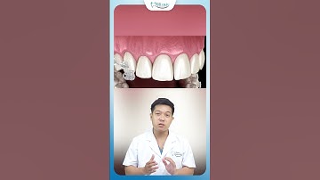 Niềng Răng Mắc Cài Sứ | Nha Khoa Minh Châu