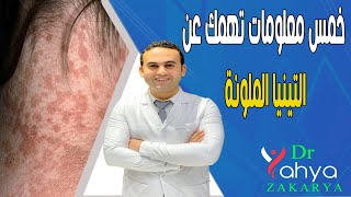  خمس معلومات تهمك عن التينيا الملونة - Pityriasis versicolour ‍