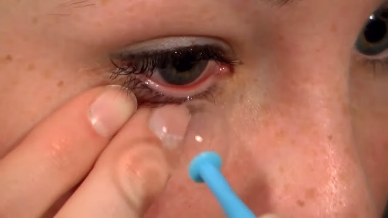 Skleralna sočiva: postavljanje, skidanje i održavanje