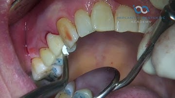 Socket Shield Technique Utilising Dr Howard Gluckman