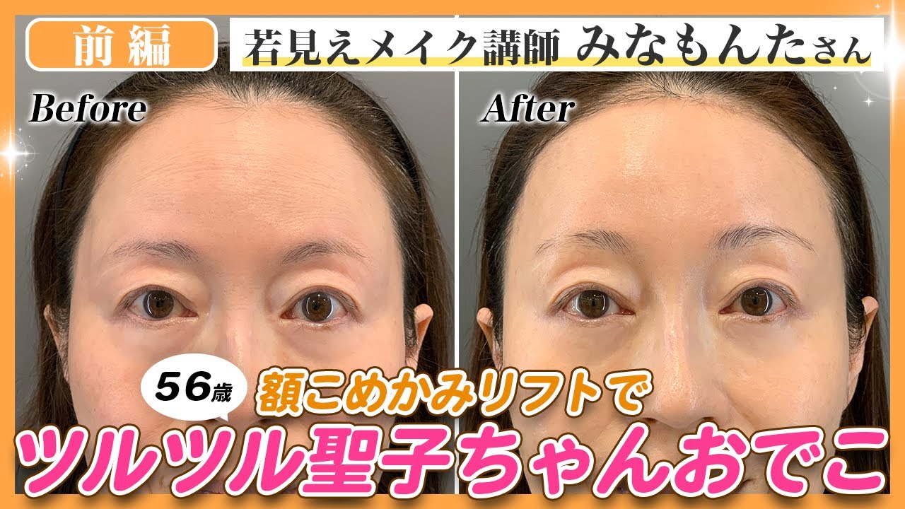 【56歳の美容整形：前編】鏡を見るたび気持ちが沈む…そんなたるみとお別れし、大成功と言われる術後に✨【#前額リフト 】