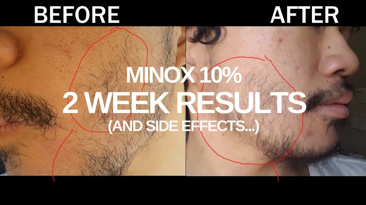 can minoxidil be used to grow beard