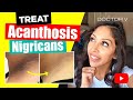 Doctor V - How To Treat Acanthosis Nigrican | Skin Of Colour | Brown Or Black Skin