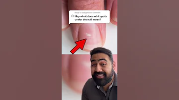 Dr Karan - What Are White Spots on Finger Nails?