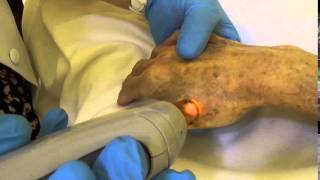 Age Spots Removal By Laser.