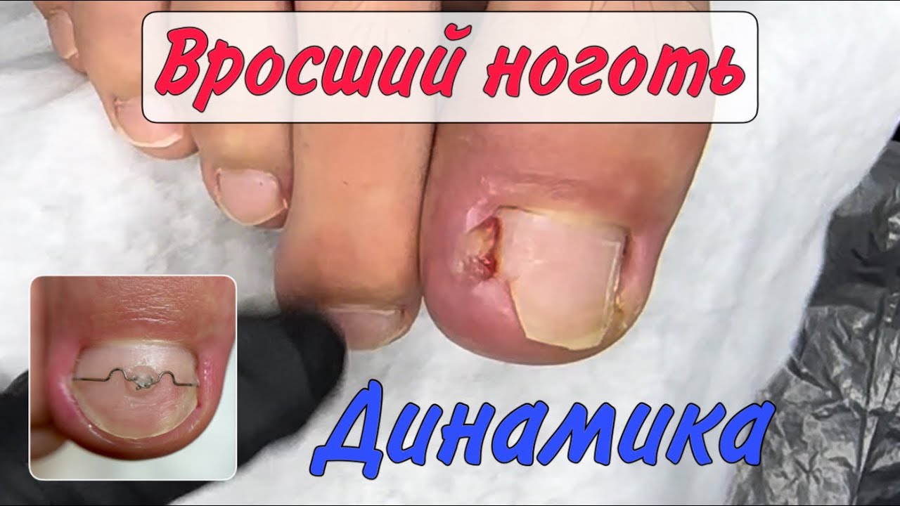 Вросший ноготь и установка скобы 3ТО - YouTube