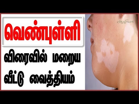 வெண்புள்ளி | Vitiligo Treatments | Vitiligo Treatment At Home | Vitiligo In Tamil | Venpulli