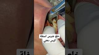 خلع ضرس اسفله خراج | dental abcess | Abcès dentaire |दंत फोड़ा | दंत फोड़ा