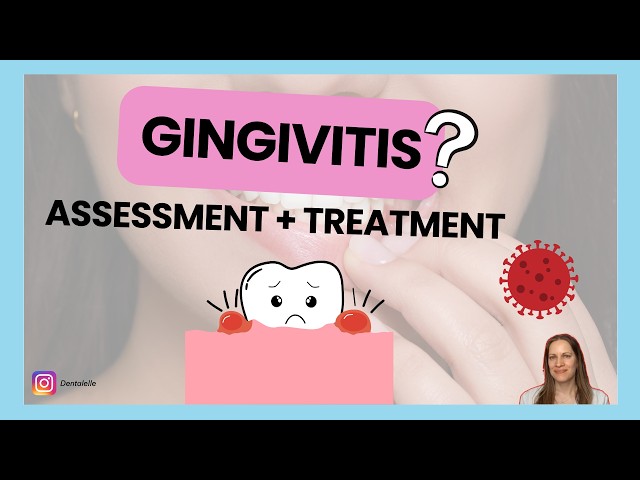 Thumbnail for How Do I Assess Gingivitis?  At Every Appointment AND Time Saving Tips
