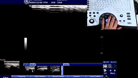 NextGen LOGIQ e: Patient Follow-up Tool with Fusion