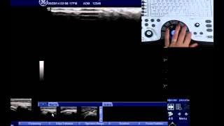 NextGen LOGIQ e: Patient Follow-up Tool with Fusion