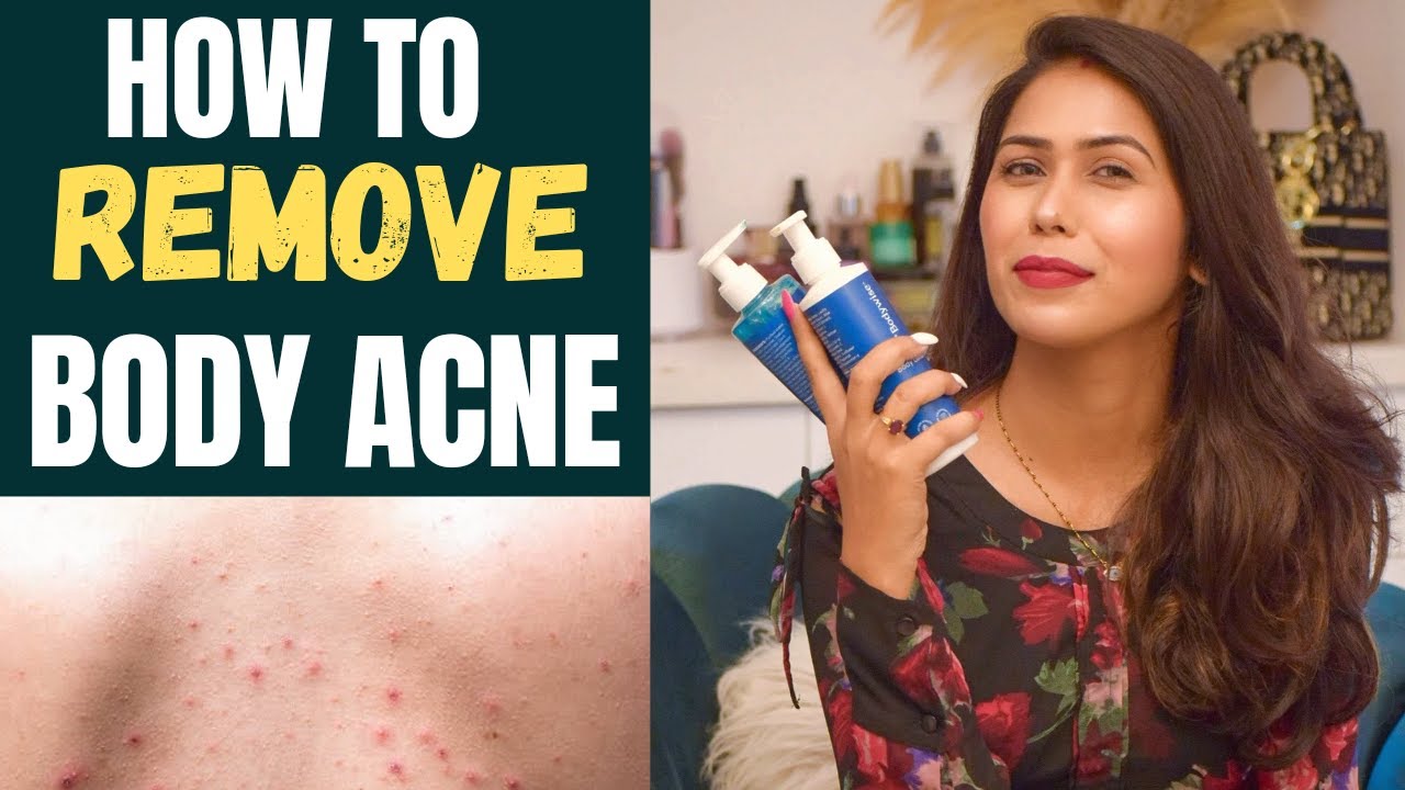 HOW TO REMOVE BODY ACNE / Body wash for back acne / Acne body wash