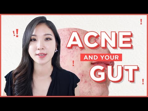 💩How To Treat Acne from the Inside Out • Acne and Gut health