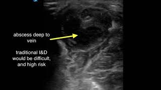Abscess Deep to Superficial Phlebitis screenshot 1