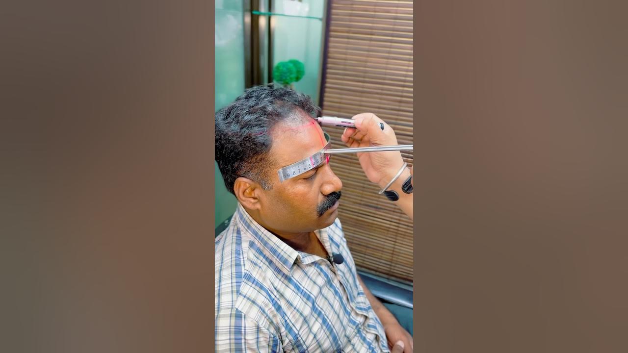 Ultimate Hair Transplant #shorts Ultimate Hair Transplant #shorts