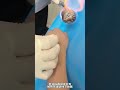 Tenosynovitis postoperative tenosynovial cyst fire needle treatment#Tenosynovitis#Ganglion
