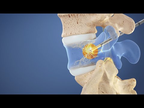 Intracept procedure to