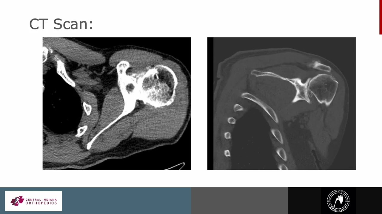 Patient Story: Stemless Lima RSA With All Poly Glenosphere