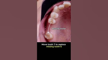 Braces move tooth 7 to replace missing molar #braces #dentist