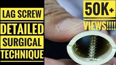 Lag Screw Technique (Small and Large Fragment)