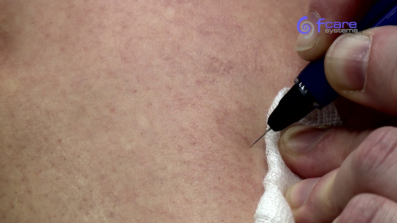 ViridexRF Telangiectasias