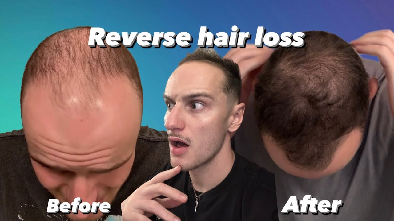 Save your hairline! Reversing hair loss: EP 1 (special guest Dr